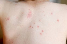 Chickenpox on a little boy's back